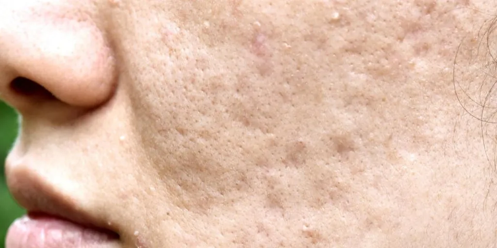 Cicatriz de acne